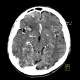 Metastasis in brain, multiple, multiple myeloma: CT - Computed tomography