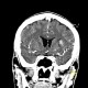 Metastasis in brain, multiple, multiple myeloma: CT - Computed tomography
