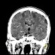 Metastasis in brain, multiple, multiple myeloma: CT - Computed tomography
