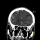 Metastasis in brain, multiple, multiple myeloma: CT - Computed tomography