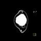 Metastasis in brain, multiple, multiple myeloma: CT - Computed tomography