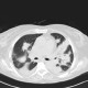 Inflammatory infiltrate of lung, pneumonia: CT - Computed tomography