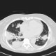 Inflammatory infiltrate of lung, pneumonia: CT - Computed tomography