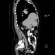 Morgagni hernia with dome of the liver: CT - Computed tomography