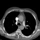 CTEPH, chronic thromboembolic disease, pulmonary hypertension, mosaic perfusion: CT - Computed tomography