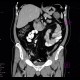 Macrocystic adenoma of pancreas: CT - Computed tomography