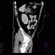 Macrocystic adenoma of pancreas: CT - Computed tomography
