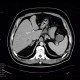 Macrocystic adenoma of pancreas: CT - Computed tomography