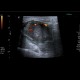 Histiocytoma, recurrence, malignant histiocytoma: US - Ultrasound