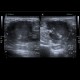 Histiocytoma, recurrence, malignant histiocytoma: US - Ultrasound