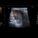 Histiocytoma, recurrence, malignant histiocytoma: US - Ultrasound