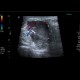 Histiocytoma, recurrence, malignant histiocytoma: US - Ultrasound