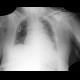 Malposition of endotracheal tube: X-ray - Plain radiograph