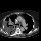 Malposition of nasogastric tube, hemothorax, pneumothorax: CT - Computed tomography