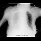 Malposition of central venous line, paravasat, fluidothorax: X-ray - Plain radiograph