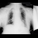 Malposition of central venous line, paravasat, fluidothorax: X-ray - Plain radiograph