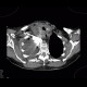 Malposition of central venous line, paravasat, fluidothorax: CT - Computed tomography