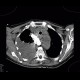 Malposition of central venous line, paravasat, fluidothorax: CT - Computed tomography