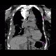 Malposition of central venous line, paravasat, fluidothorax: CT - Computed tomography