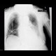Pneumothorax, malposition of nasojejunal tube: X-ray - Plain radiograph