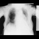 Pneumothorax, malposition of nasojejunal tube: X-ray - Plain radiograph