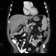 Previous examination with normal liver parenchyma: CT - Computed tomography