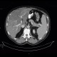Liver steatosis, geographic, focal: CT - Computed tomography