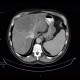 Liver steatosis, geographic, focal: CT - Computed tomography