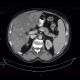 Liver steatosis, geographic, focal: CT - Computed tomography