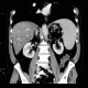 Liver steatosis, geographic, focal: CT - Computed tomography