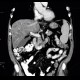 Liver steatosis, geographic, focal: CT - Computed tomography
