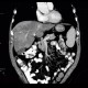 Liver steatosis, geographic, focal: CT - Computed tomography
