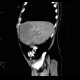 Liver steatosis, geographic, focal: CT - Computed tomography