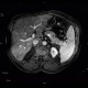 Liver steatosis, geographic, focal: MRI - Magnetic Resonance Imaging
