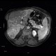 Liver steatosis, geographic, focal: MRI - Magnetic Resonance Imaging