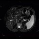 Liver steatosis, geographic, focal: MRI - Magnetic Resonance Imaging