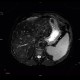Liver steatosis, geographic, focal: MRI - Magnetic Resonance Imaging