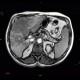 Liver steatosis, geographic, focal: MRI - Magnetic Resonance Imaging