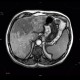 Liver steatosis, geographic, focal: MRI - Magnetic Resonance Imaging