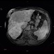 Liver steatosis, geographic, focal: MRI - Magnetic Resonance Imaging