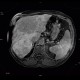 Liver steatosis, geographic, focal: MRI - Magnetic Resonance Imaging