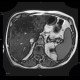 Liver steatosis, geographic, focal: MRI - Magnetic Resonance Imaging