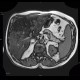 Liver steatosis, geographic, focal: MRI - Magnetic Resonance Imaging