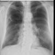 Bullous emphysema: X-ray - Plain radiograph