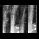 Laryngeal dysphagia: RF - Fluoroscopy