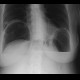 Pneumoperitoneum, massive, ascites: X-ray - Plain radiograph