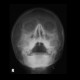 Maxillary sinusitis: X-ray - Plain radiograph