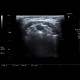 Medial cervical cyst: US - Ultrasound