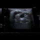 Cervical cyst, medial, retention cyst: US - Ultrasound