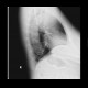Mediastinal expansion: X-ray - Plain radiograph